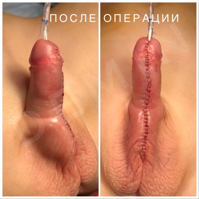 Гипоспадия - оперирует Никита Валерьевич