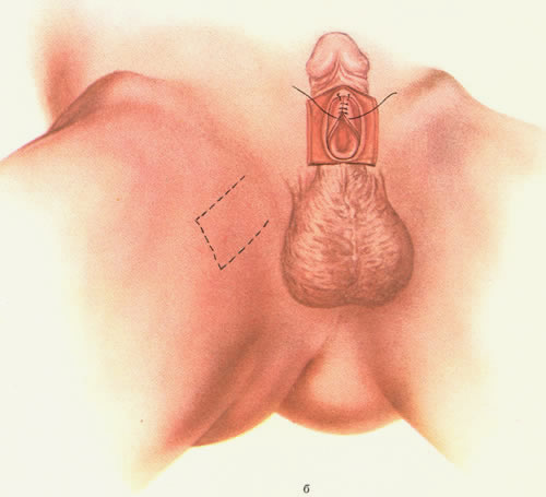 Лечение свища уретры, фото